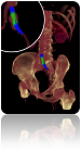 Virtual Stenting Iliac
